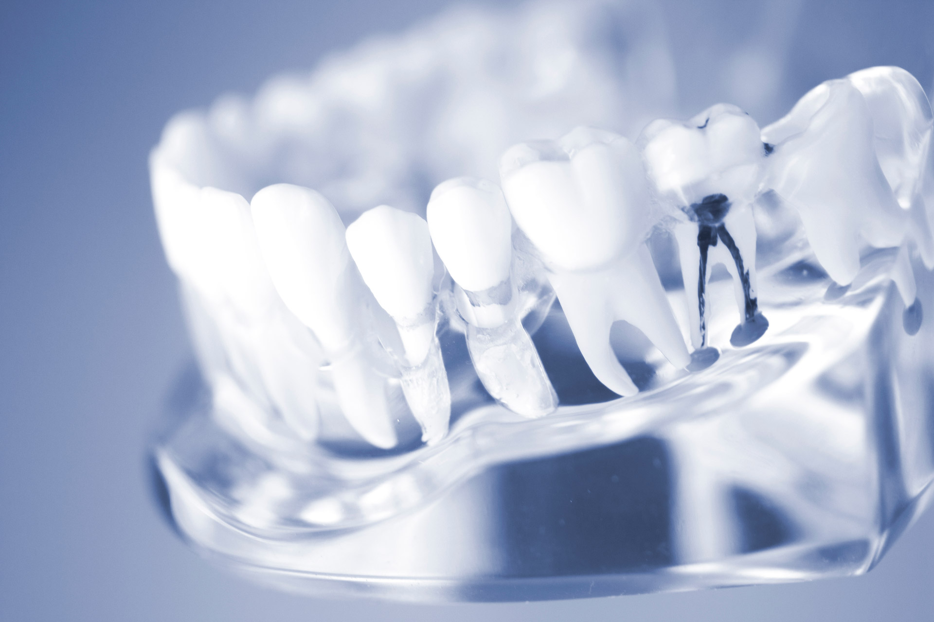 Wurzelbehandlung zum Erhalt des Zahns