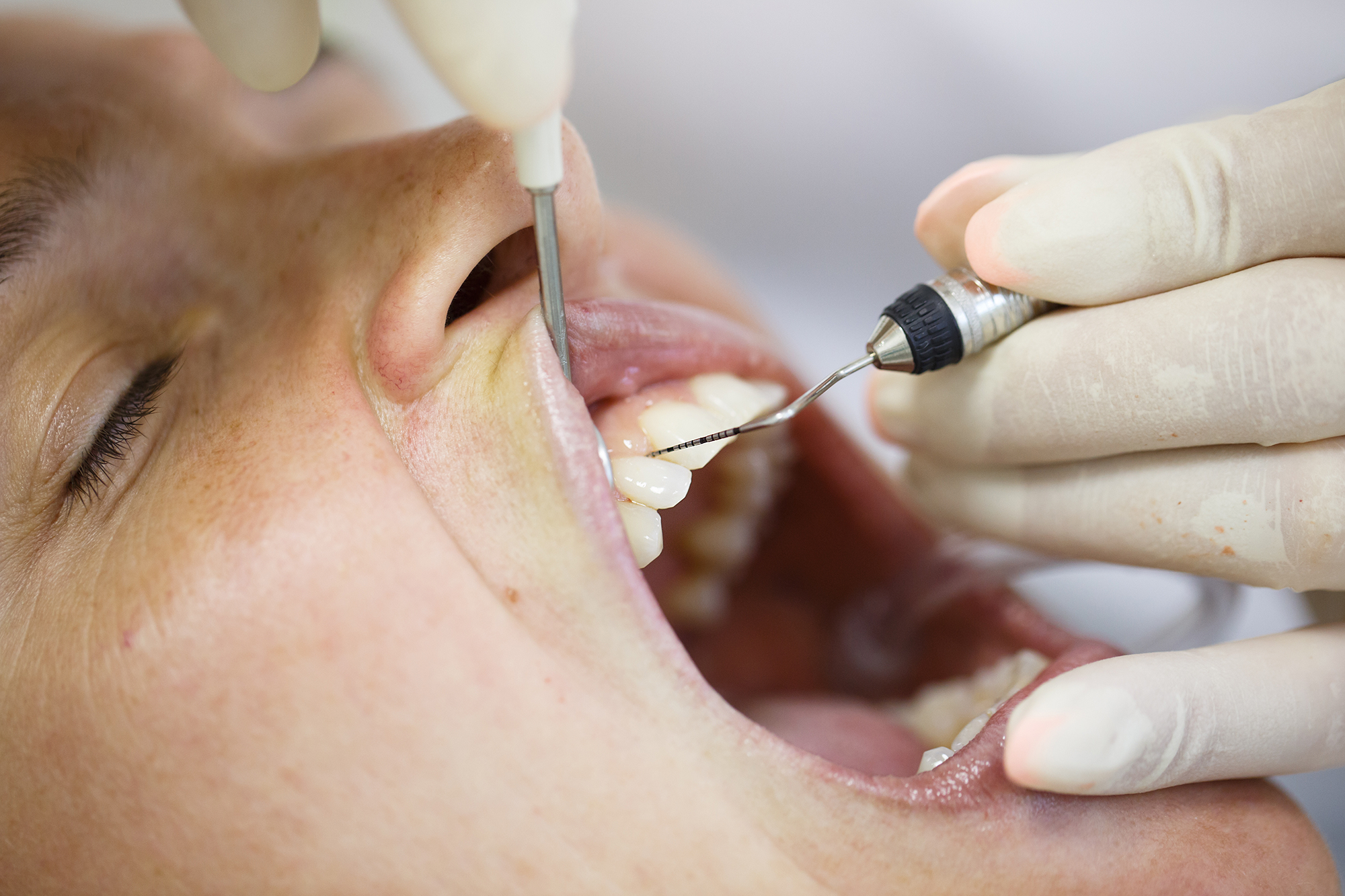 Eine Zahnfleischbehandlung ist ein effektives Mittel gegen Zahnfleischentzündungen